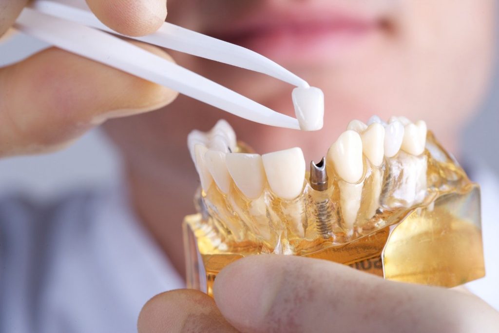 cấy ghép implant assure dental